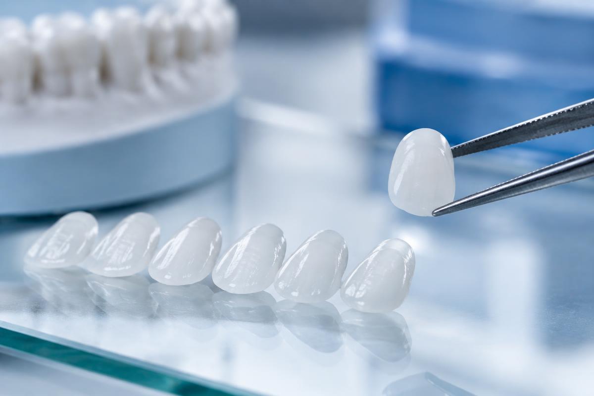 Dental Veneers